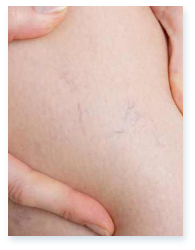 State-of-the-art vein treatment