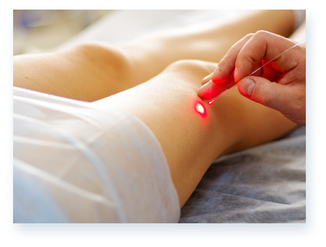 Varicose veins illustration